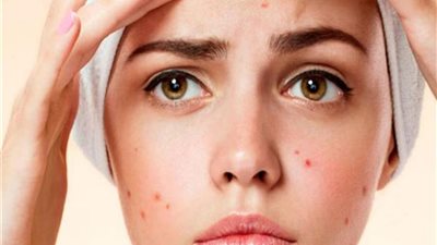  4 وصفات طبيعية تخلصك من حب الشباب نهائيًا