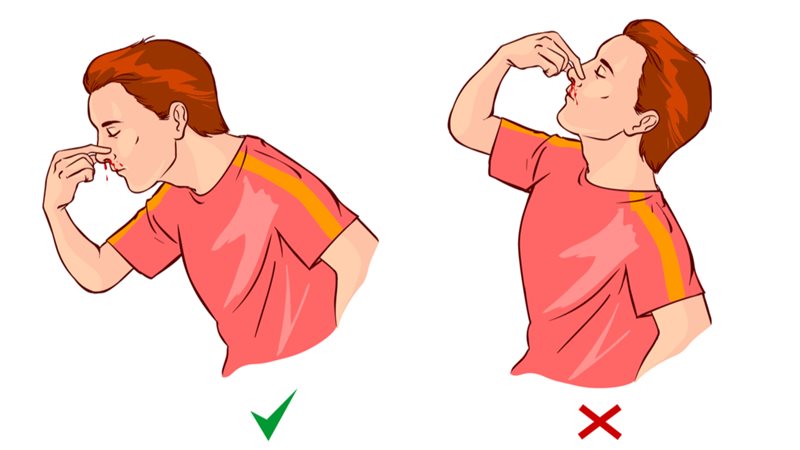 نزيف الانف
