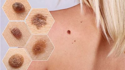 دراسة صادمة: ممارسة هذا النوع من الرياضة تصيبك بسرطان الجلد!