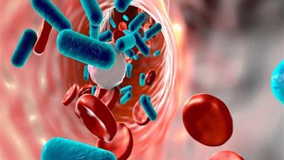 تعفن الدم أخطر مضاعفات إزالة الأورام السرطانية «القاتل الصامت»