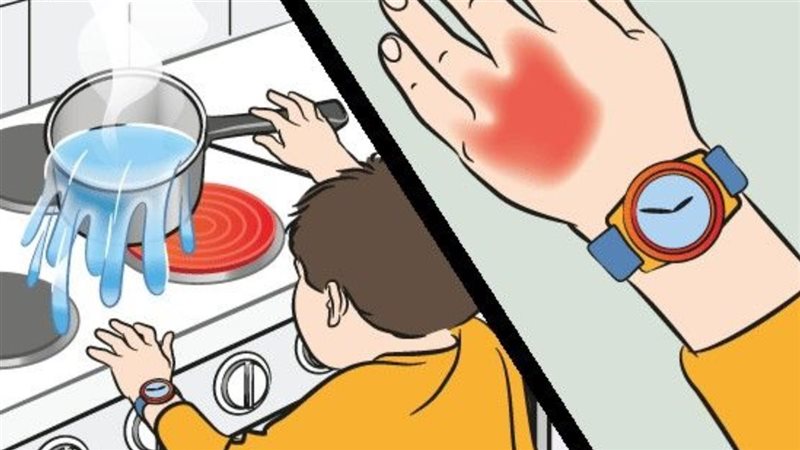 إسعافات أولية لحروق
