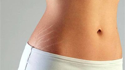 كيفية التخلص من آثار السيلوليت بعد الولادة