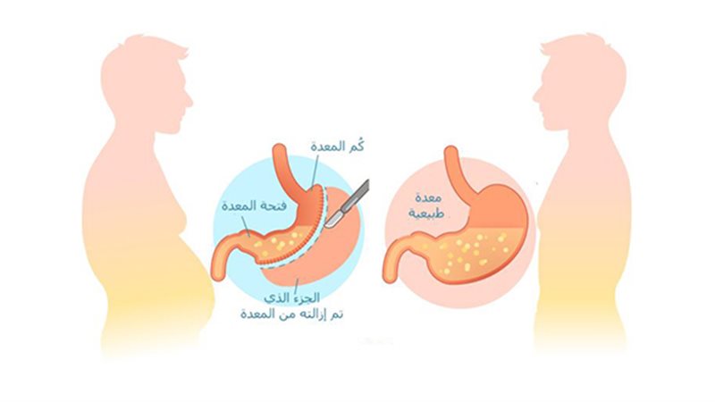 عملية تكميم المعدة