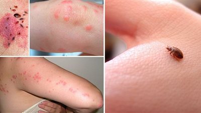 بق الفراش وباء يضرب العاصمة الفرنسية باريس