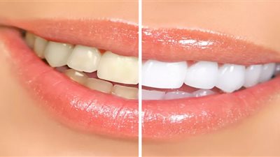 وصفة النشا لتبيض الأسنان بأقل التكاليف «عززي ثقتك بابتسامة جذابة»