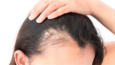 3 زيوت طبيعية وفعالة لإنبات الشعر من الجذور 