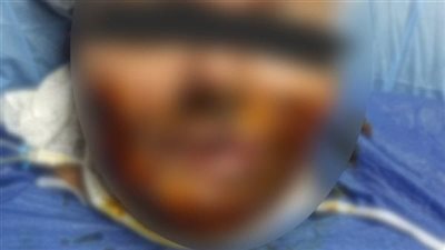 مفاجآت صادمة في أقوال شقيقة ضحايا التشويه بمية النار في منشأة القناطر