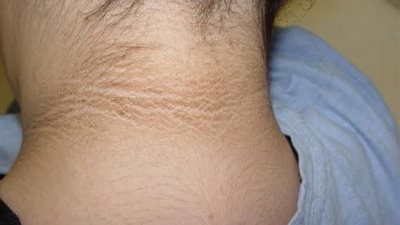 4 وصفات لتبييض الرقبة من مطبخك (إنفوجراف)