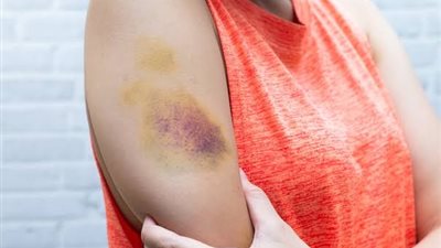 4 أسباب تؤدى إلى الإصابة بتجلطات الدم