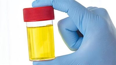 6 علامات مرضية يكشفها البول عن صحتك 