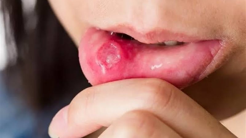 اسباب قرحات الفم