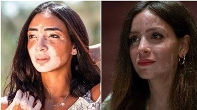 3 أسباب لمرض البهاق وطرق العلاج 