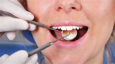 هل يجوز حشو الأسنان بالذهب؟ «الإفتاء تُجيب»