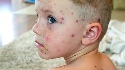 3 خطوات ضرورية لحماية طفلك من الجدري المائي 
