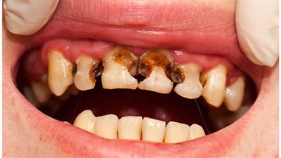3 أعراض لتأثير مرض السكري على الأسنان 