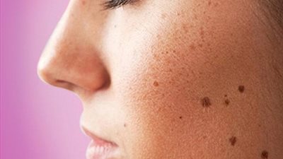 4 فيتامينات تمنع تصبغات البشرة 