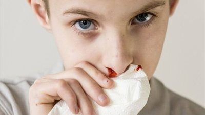 3 أسباب لنزيف الأنف عند الأطفال 