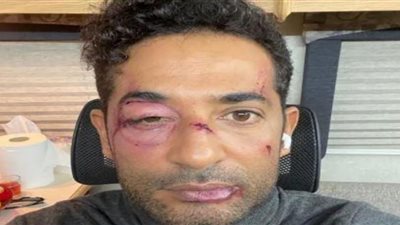 أول تعليق من عمرو سعد بعد صورته بالكدمات والجروح