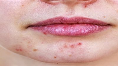 6 ممارسات خاطئة تعرضك لظهور بثور وحبوب الوجه 