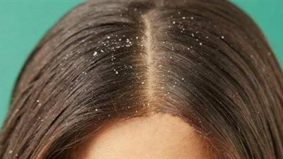 3 فوائد للخل في علاج قشرة الشعر