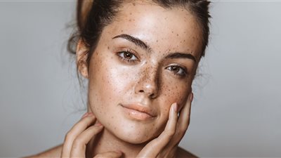  وصفات طبيعية فعالة للتخلص من النمش