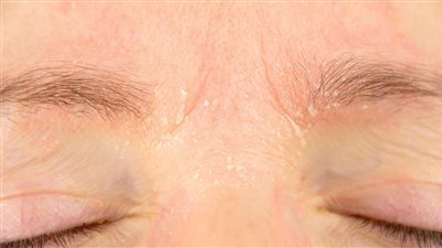 لجمال وجهك | 5 وصفات طبيعية تخلصك من قشر الحواجب