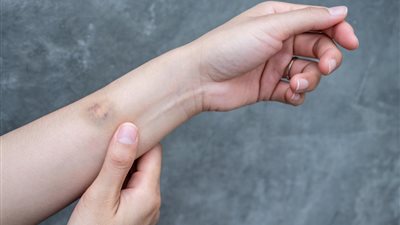 ما سبب ظهور الكدمات في الجسم بشكل مفاجئ؟ وطرق العلاج