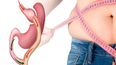 8 مخاطر لعملية تكميم المعدة الجراحية